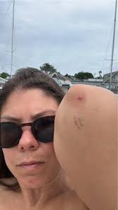 I bumped my elbow and now it has a protuberance