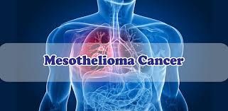 When cancerous tumors form on connective tissues, it is a sarcoma. Amazon Com Mesothelioma Cancer Best Info Mesothelioma Cancer Apps Games