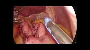 laparoscopic roux en y gastric byp