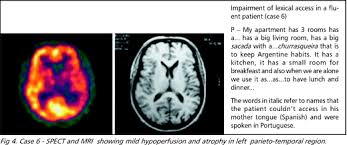A característica de uma doença degenerativa é que a tendência é sempre de piora, com ou sem tratamento, explica o. Scielo Brasil Primary Progressive Aphasia Analisys Of 16 Cases Primary Progressive Aphasia Analisys Of 16 Cases