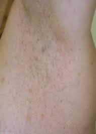 Norofibromatozis Dr Bulent Aldemir