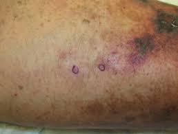 Purpura not due to a low platelet count, caused by inflammation in blood vessels of the skin, is the hallmark of hsp. Fever And A Rash Dermnet Nz
