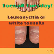 Image result for Beau lines feet