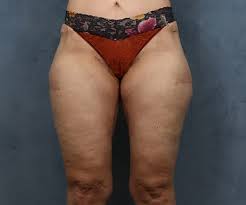 Thigh Lift Surgery Houston Tx