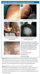 Identifying And Managing Fungal Skin Infections Ringworm, also known as dermatophytosis, is a highly contagious form of skin fungus, and if you have a history of skin or fungal infections, schedule an appointment with a dermatologist. managing fungal skin infections