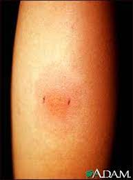 Hi, friends, we know in this video what is ppd or mantoux test. Positive Ppd Skin Test Medlineplus Medical Encyclopedia Image