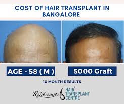 Welcome to the official page of esteem hairdressing for bookings pls. Hair Transplant Cost In Bangalore Hair Transplant Clinic Bengaluru