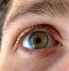A) pathochromia or psora are multiple sporadic pigments ( brown & orange) granulation of intense concentration. How To Know If I Have Central Heterochromia Or Hazel Eyes Quora