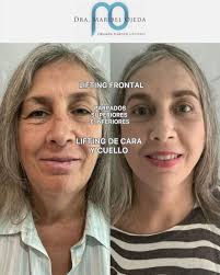 El estiramiento facial es un procedimiento que devuelve firmeza y  luminosidad sin alterar tu expresión natural. Gracias a la precisión  quirúrgica y experiencia del Dr. Nelson Negrón, el resultado es un  rejuvenecimiento