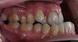 Braces would also be a good way of resolving this kind of problem. Quiz Do I Need Braces South Surrey Smiles