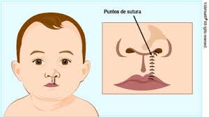 En ocasiones, la úvula o campanilla puede. Paladar Hendido Y Labio Leporino Para Padres Nemours Kidshealth