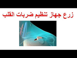 The pacemaker's pulse generator sends electrical impulses to the heart to help it pump properly. Ø¬Ù‡Ø§Ø² ØªÙ†Ø¸ÙŠÙ… Ø¶Ø±Ø¨Ø§Øª Ø§Ù„Ù‚Ù„Ø¨ Ø£Ø¬Ù‡Ø²Ø© ØªÙ†Ø¸ÙŠÙ… Ø¶Ø±Ø¨Ø§Øª Ø§Ù„Ù‚Ù„Ø¨ Ùˆ ÙˆØ¸ÙŠÙØªÙ‡Ø§ Ùˆ ØªØ±ÙƒÙŠØ¨Ù‡Ø§
