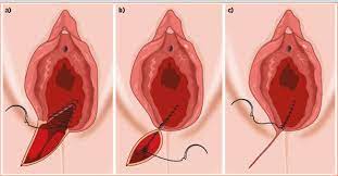 How To Repair An Episiotomy