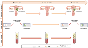 Molecular Differential Diagnosis Of Uterine Leiomyomas And Leiomyosarcomas