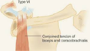 Ligaments are soft tissue structures that connect bones to bones. Acromioclavicular Joint Injury Brown Emergency Medicine