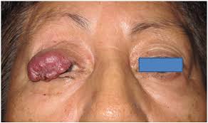 The growth is usually removed surgically. Cancers Free Full Text Merkel Cell Carcinoma Of The Eyelid And Periocular Region Html