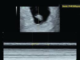 An Imaging Approach To Early Pregnancy Failure Contemporary Ob Gyn