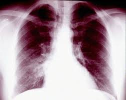 Atelectasis is one of the most common breathing (respiratory) complications after surgery. Rounded Atelectasis Of The Lung Sciencedirect