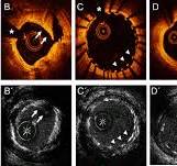 High-definition Intravascular Ultrasound Vs Optical ...