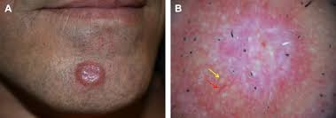 Image result for Trombicula autumnalis bites