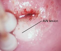 Image result for Colposcopy Findings