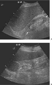 Your doctor may use renal ultrasound, body ct, mr or ct urography, body mri, renal scintigraphy, or biopsy to help diagnose your condition. Chronic Renal Failure Radiology Key