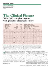 Image result for Pulseless Electrical Activity