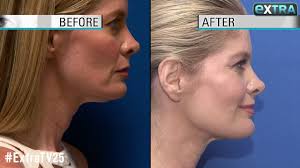 Maybe you would like to learn more about one of these? How To Take Years Off Your Neck Youtube