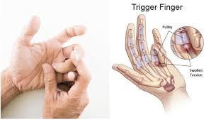 Nyeri pergelangan tangan adalah rasa sakit pada pergelangan tangan yang bisa disebabkan oleh pegal, kesemutan, atau mati rasa pada pergelangan tangan. Apakah Trigger Finger Ini 6 Perkara Perlu Tahu Bila Jari Jammed