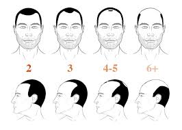 norwood 2 hairline 3 ways to stop it naturally before it