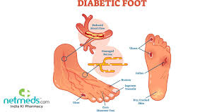 It is also important for balance: Diabetic Foot Infection Causes Symptoms And Treatment