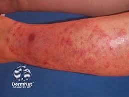 Image result for allergy rash on the legs