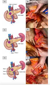 Cancer of the pancreas, a large gland deep in the abdomen, is an especially complex illness. Margin Accentuation For Resectable Pancreatic Cancer Using Irreversible Electroporation Results From The Macpie I Study European Journal Of Surgical Oncology