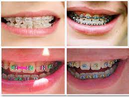 Fake Braces She Wears Blog
