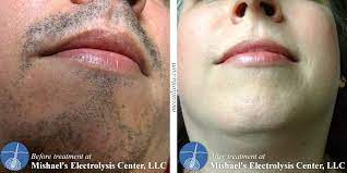 I'm looking into electrolysis for my upper lip answer: Before After Electrolysis Hair Removal Mishael S Electrolysis Center