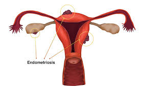 Endometriosis is a condition in which cells similar to those in the endometrium, the layer of tissue that normally covers the inside of the uterus, grow outside the uterus. Ø§Ù„Ø§Ù†ØªØ¨Ø§Ø° Ø§Ù„Ø¨Ø·Ø§Ù†ÙŠ Ø§Ù„Ø±Ø­Ù…ÙŠ Endometriosis Ù…Ø§Ø°Ø§ Ø§Ù„Ù†Ù‡Ø§Ø±