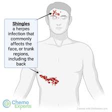 Image result for shingles