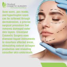 Dermabrasion for Acne Scars & Smooth Skin