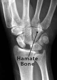 Image result for Hamate Bone