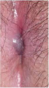 Image result for itchy skin rectum