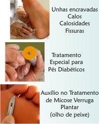 Calos Nos Pés Olho De Peixe Unhas Encravadas Calos Calosidades Fissuras Tratamento Especial Pra Pes Diabetic Tratamento Para Os Pes Unhas Com Micose Tratamento De Unhas Com Micose