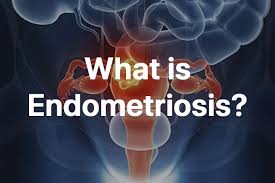 Although the exact cause of endometriosis is not certain, possible explanations include: Endometriosis Symptoms Causes Treatment Magview