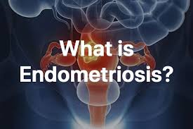 Consult a doctor for medical advice. Endometriosis Symptoms Causes Treatment Magview
