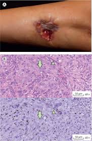 Image result for Sarcoma