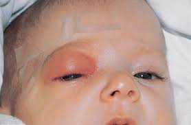 Image result for phlegmon on face)