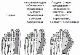 как лечить косточку на ноге в домашних условиях отзывы Kak Izbavitsya Ot Shishki Kostochki Na Noge U Bolshogo Palca Narodnymi Sredstvami