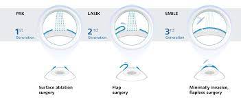 In situ is latin for in position. Smile Laser Eye Surgery Laservue Lasik Cataract Center