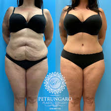 The abdominoplasty was about $11,000 of that. 47f 4 Months After Mommy Makeover Petrungaro Plastic Surgery