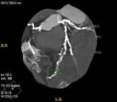 In geometry, a diagonal is a line segment joining two vertices of a polygon or polyhedron, when those vertices are not on the same edge. 3 D Map Of Coronary Arteries Lad Left Descending Coronary Artery D1 Download Scientific Diagram
