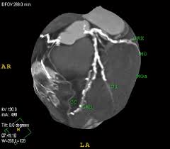 It is a diagonal artery simply because it runs diagonally the exact number of arteries in any one person are determined by genetics. 3 D Map Of Coronary Arteries Lad Left Descending Coronary Artery D1 Download Scientific Diagram